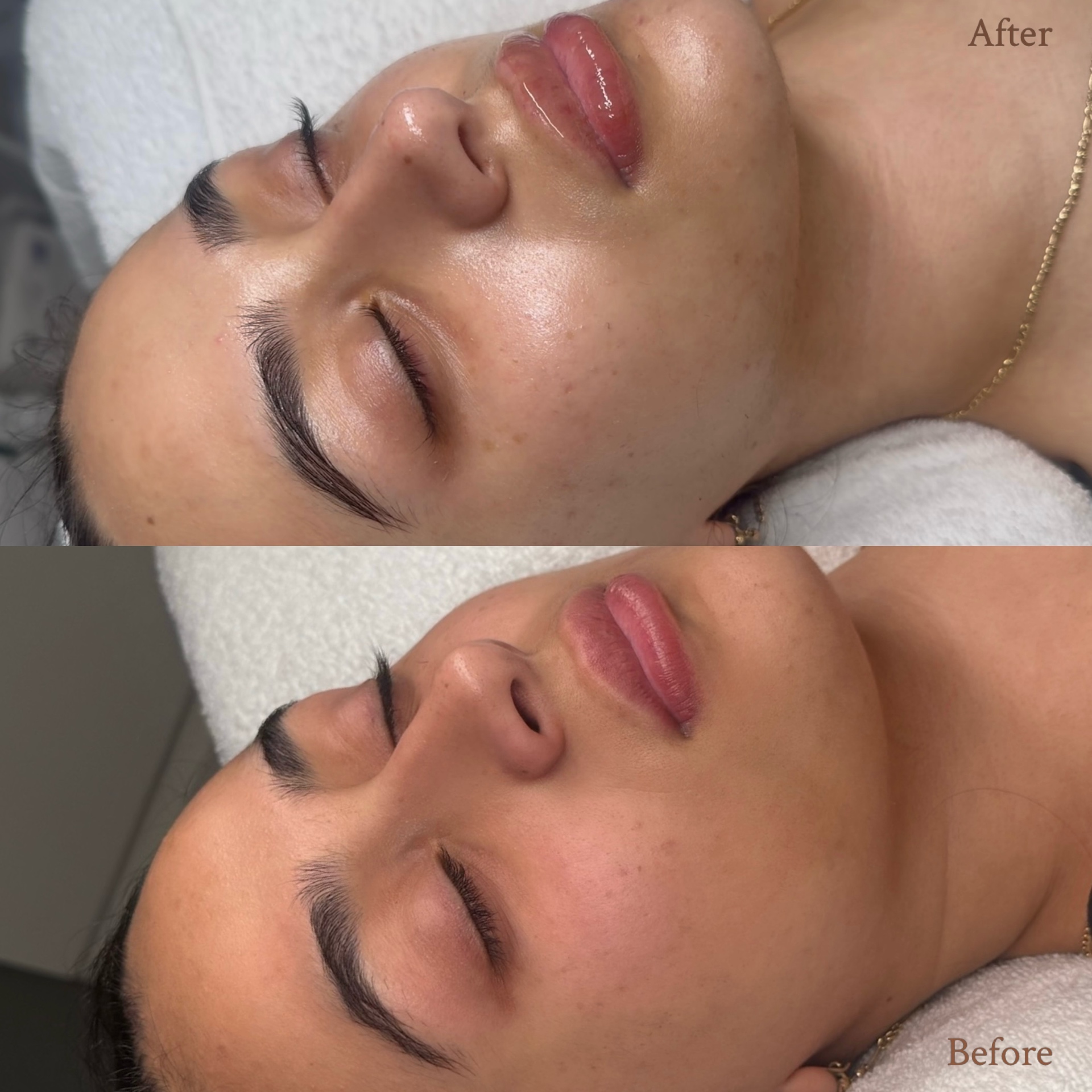 Before and after a customised facial treatment