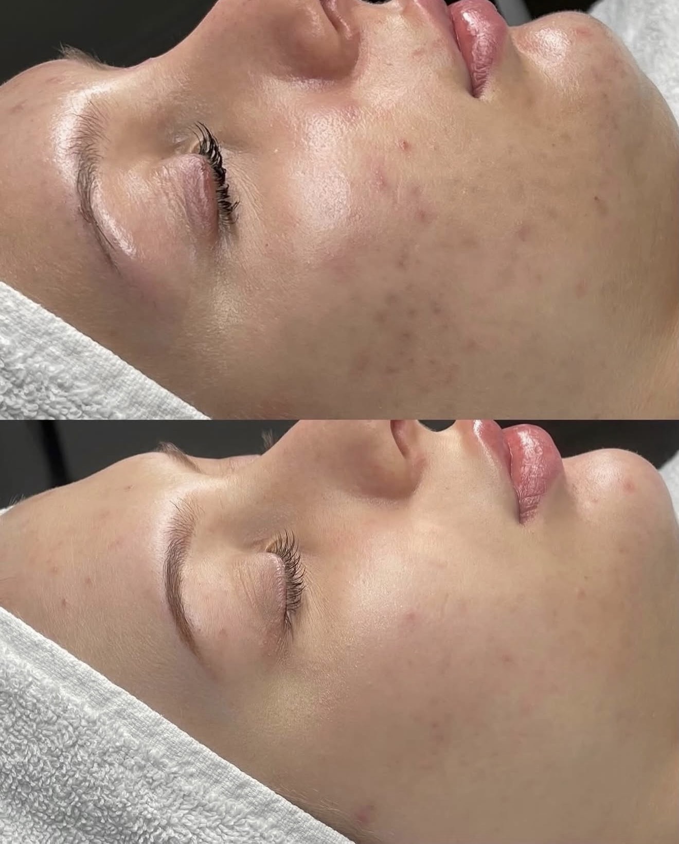 Before and after skin texture and congestion improvement